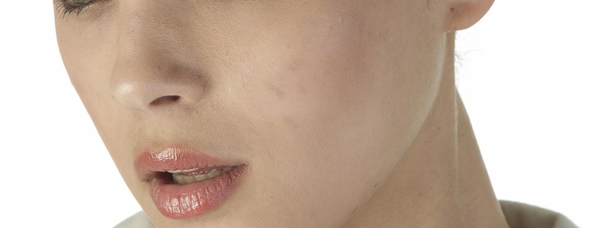 Cicatrici da acne cause e prevenzione