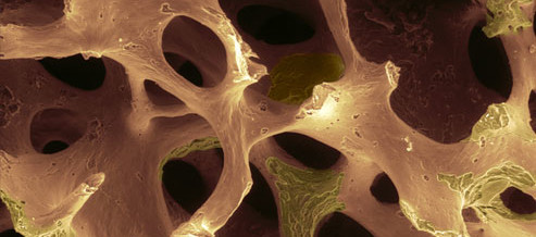 Osteoporosi
