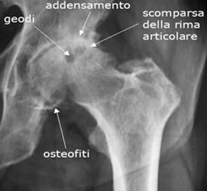RX Coxartrosi